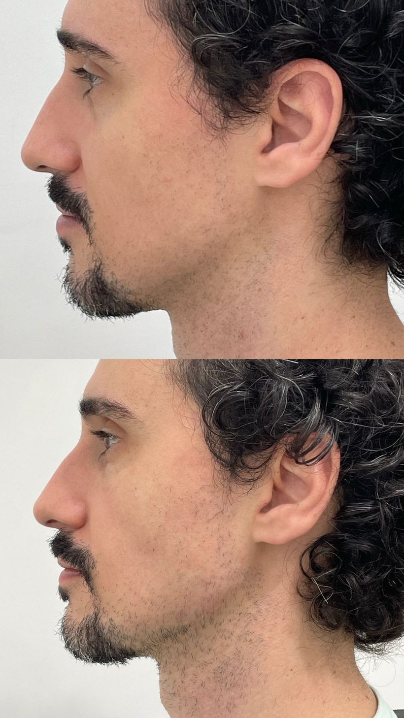 Resultado de contorno mandibular