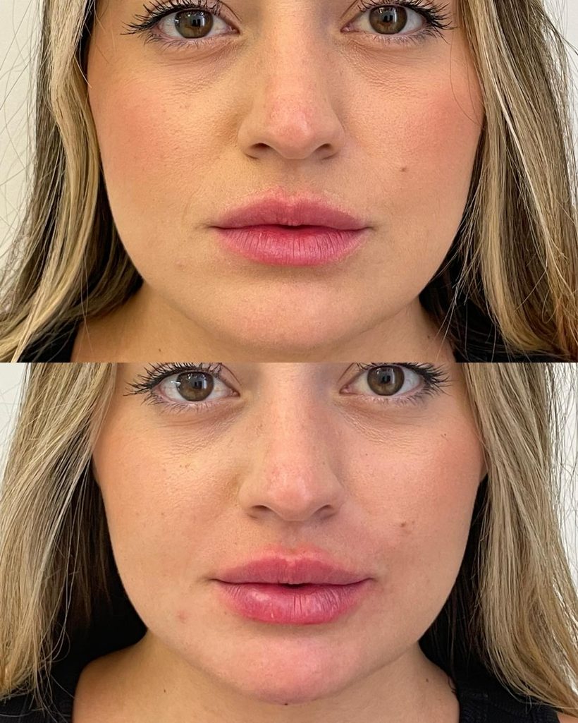Resultado de preenchimento labial