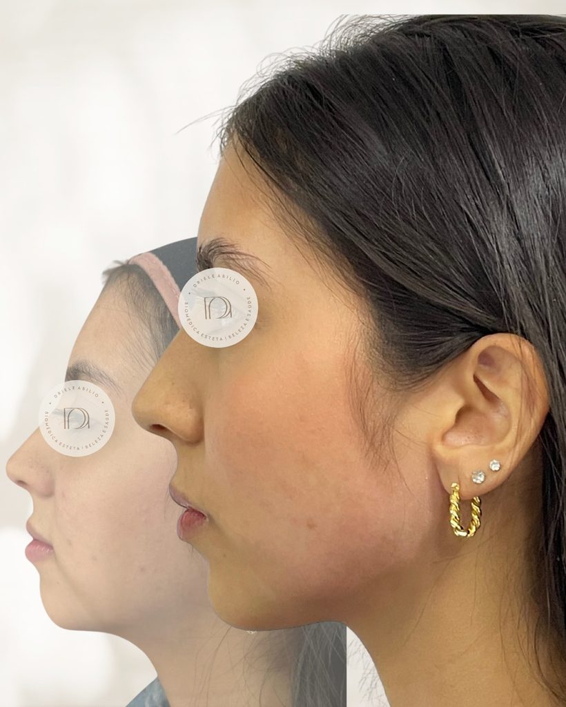 Resultado de harmonização facial