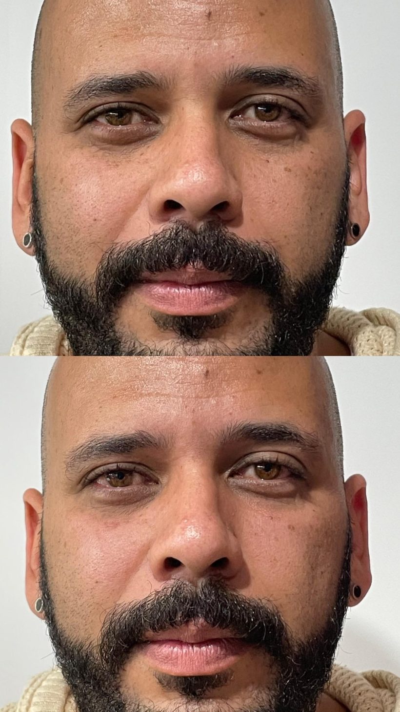 Resultado de harmonização facial